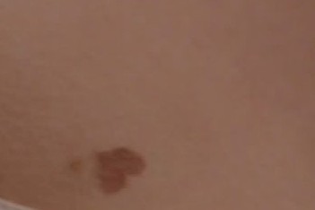 Heart-shaped-birthmark-on-stomach.jpg